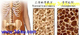 医学模型 骨质疏松的图片